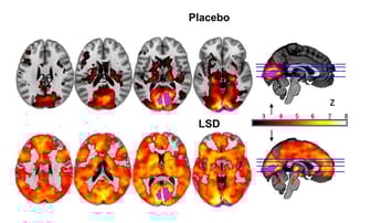 LSD brain scan Imperial beckley foundation