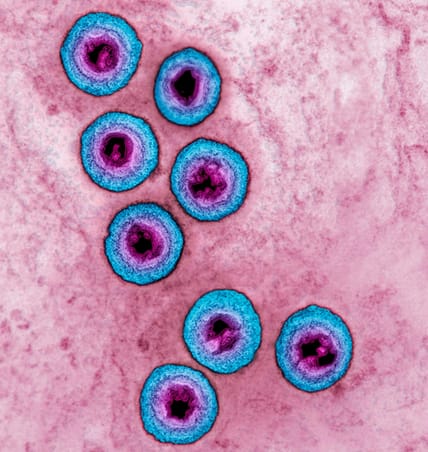 herpes-simplex.jpg