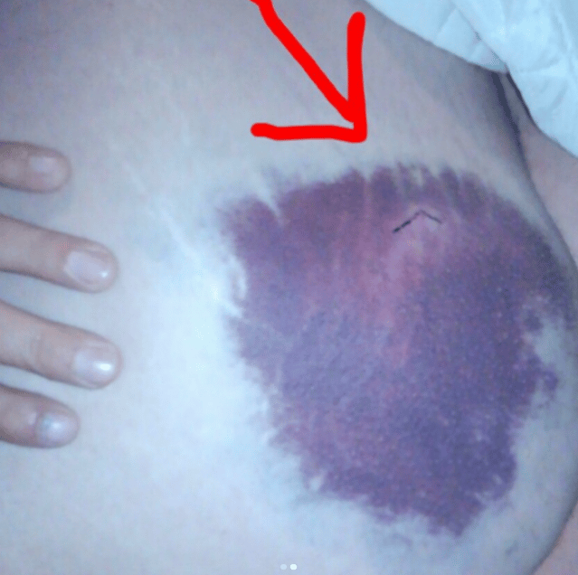 Bruise