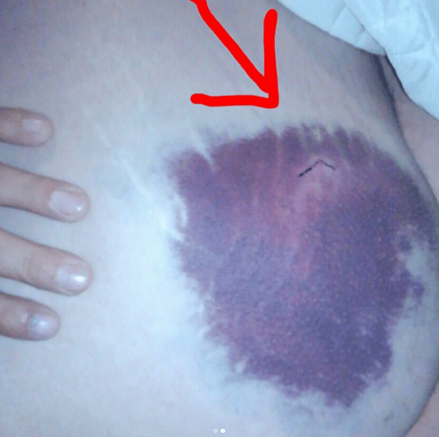 Bruise