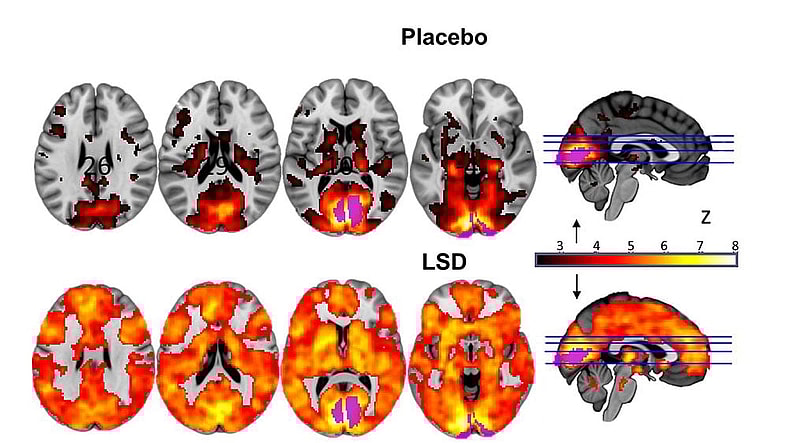 LSD brain scan Imperial beckley foundation