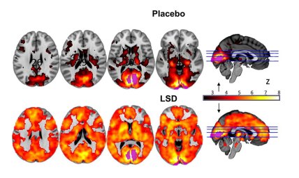 LSD brain scan Imperial beckley foundation